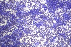 Small cell carcinoma