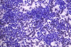 Small cell carcinoma