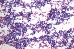 Small cell carcinoma