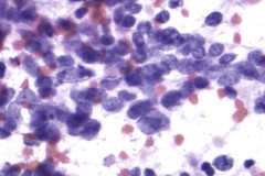 Small cell carcinoma