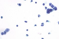 Small cell carcinoma