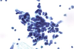 Small cell carcinoma