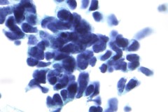 Small cell carcinoma