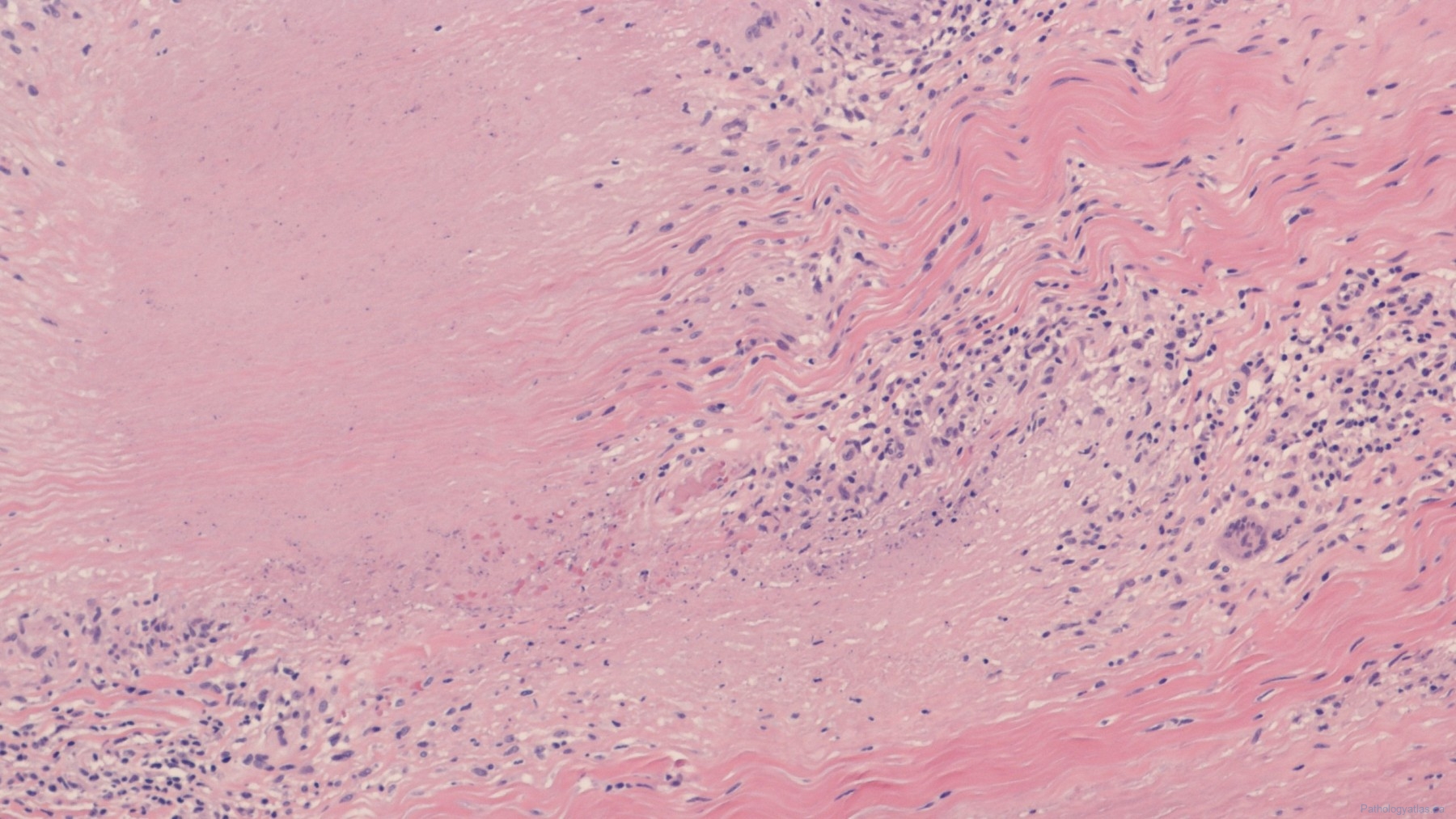 Rheumatoid nodules | Atlas of Pathology