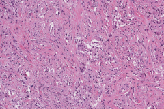 Rosai-Dorfman disease of the orbit