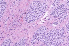 Round cell sarcoma with EWSR1-NFATC2 fusion