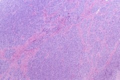 Round cell sarcoma with EWSR1-NFATC2 fusion