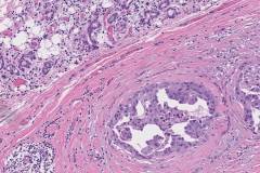 Salivary duct carcinoma ex pleomorphic adenoma