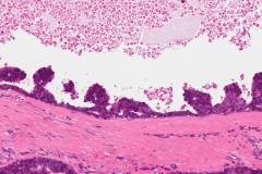 Salivary duct carcinoma