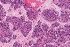 Salivary duct carcinoma ex pleomorphic adenoma