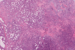 Salivary duct carcinoma ex pleomorphic adenoma