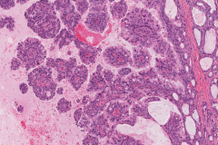 Salivary duct carcinoma ex pleomorphic adenoma