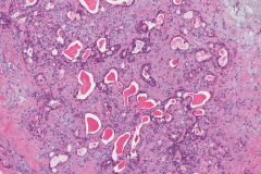 Salivary duct carcinoma ex pleomorphic adenoma