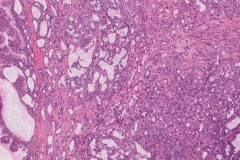 Salivary duct carcinoma ex pleomorphic adenoma