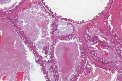 Salivary duct carcinoma