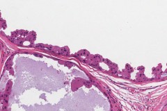 Salivary duct carcinoma