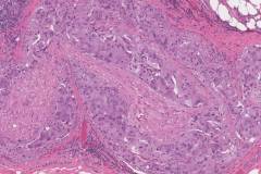 Salivary duct carcinoma of the parotid gland