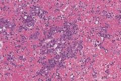 Acinic cell carcinoma of the parotid gland