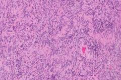 Schwannoma