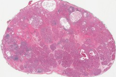 Sclerosing polycystic adenoma