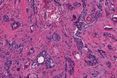 Sclerosing mucoepidermoid carcinoma with eosinophilia of the thyroid gland