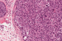 Sebaceous cell carcinoma involving the eyelid