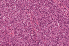 Sebaceous cell carcinoma involving the eyelid