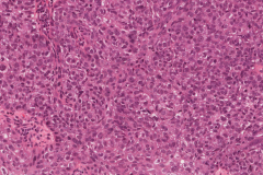 Sebaceous cell carcinoma involving the eyelid