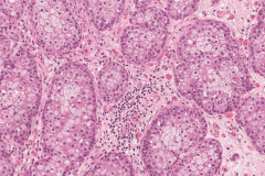 Sebaceous cell carcinoma involving the eyelid