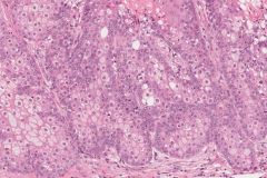 Sebaceous cell carcinoma involving the eyelid