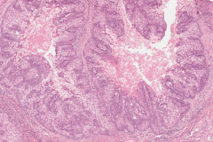 Sebaceous cell carcinoma involving the eyelid