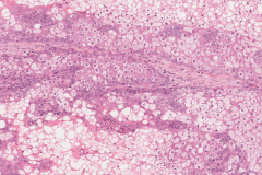 Sebaceous cell carcinoma involving the eyelid