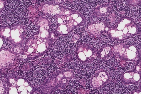 Sebaceous lymphadenoma of the salivary glands | Ottawa Atlas of Pathology