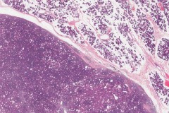 Sebaceous lymphadenoma of the parotid gland