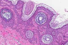 Seborrheic keratosis