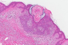 Seborrheic keratosis