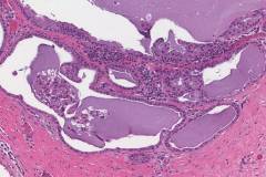 Secretory carcinoma of the palate