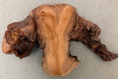 Septate uterus