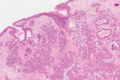 Seromucinous hamartoma of the sinonasal tract