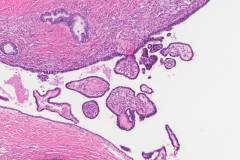 Serous borderline tumour with microinvasion of the ovary