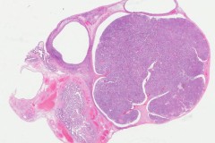 Serous borderline tumour of the ovary