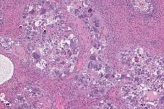 Metastatic serous carcinoma of the uterus to the ovary