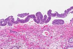 Serous carcinoma arising in an endometrial polyp