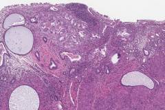 Serous carcinoma of the uterus