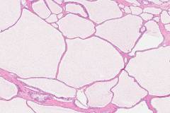 Serous cystadenoma of the pancreas