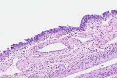 Serous intraepithelial carcinoma of the endometrium