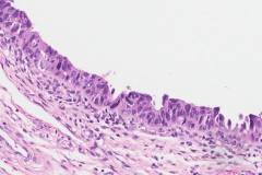 Serous intraepithelial carcinoma of the endometrium