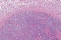 Sertoli cell tumour of the testis