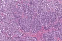 Sertoli cell tumour of the testis