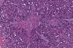 Sertoli cell tumour of the testis